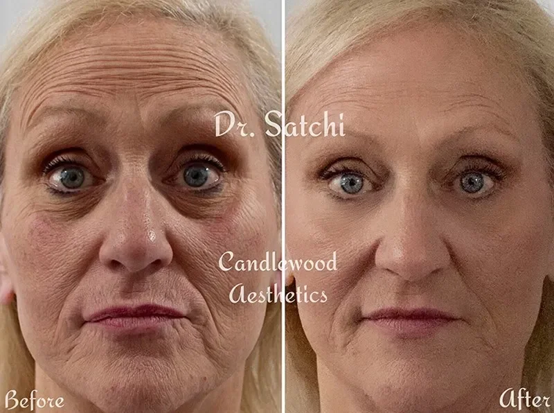Side-by-side comparison of a woman's face before and after aesthetic treatment, showing smoother skin and reduced wrinkles after treatment at Candlewood Aesthetics.