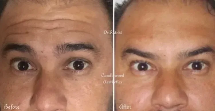Side-by-side comparison of a man's face before and after skincare treatment, showing improved skin texture and reduced pigmentation in the after image.