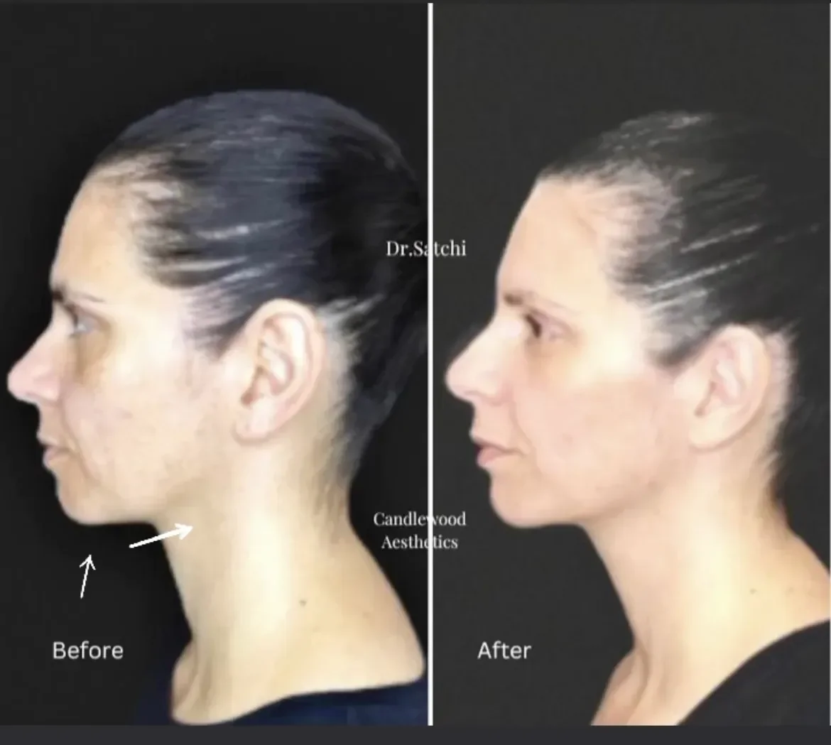 Side-by-side comparison showing a woman's profile before and after a cosmetic procedure, highlighting her neck and jawline.