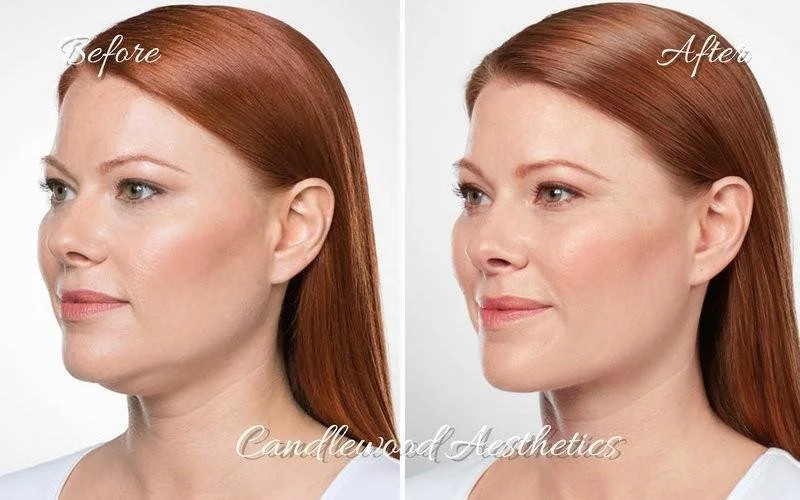 Side-by-side comparison of a woman before and after cosmetic treatment, showing smoother skin and more defined facial features in the after photo