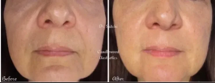 Side-by-side before and after images of a woman's face showing reduced wrinkles and a smoother complexion after a cosmetic procedure.