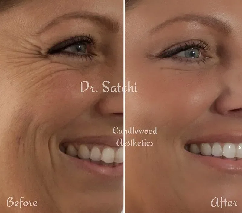 Side-by-side comparison of a woman's face showing before and after cosmetic treatment. The 'before' side has more visible wrinkles around the eye and mouth, while the 'after' side appears smoother with fewer wrinkles, and both sides show a smile with