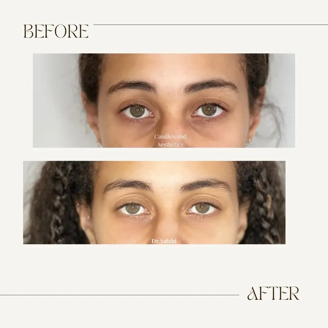 Comparison of a woman's eyes before and after eyelid surgery, showing improvements in eyelid appearance, with the words 'BEFORE' and 'AFTER' at the top and bottom respectively, and the text 'Candlewood Aesthetics' and 'Dr. Satchi'
