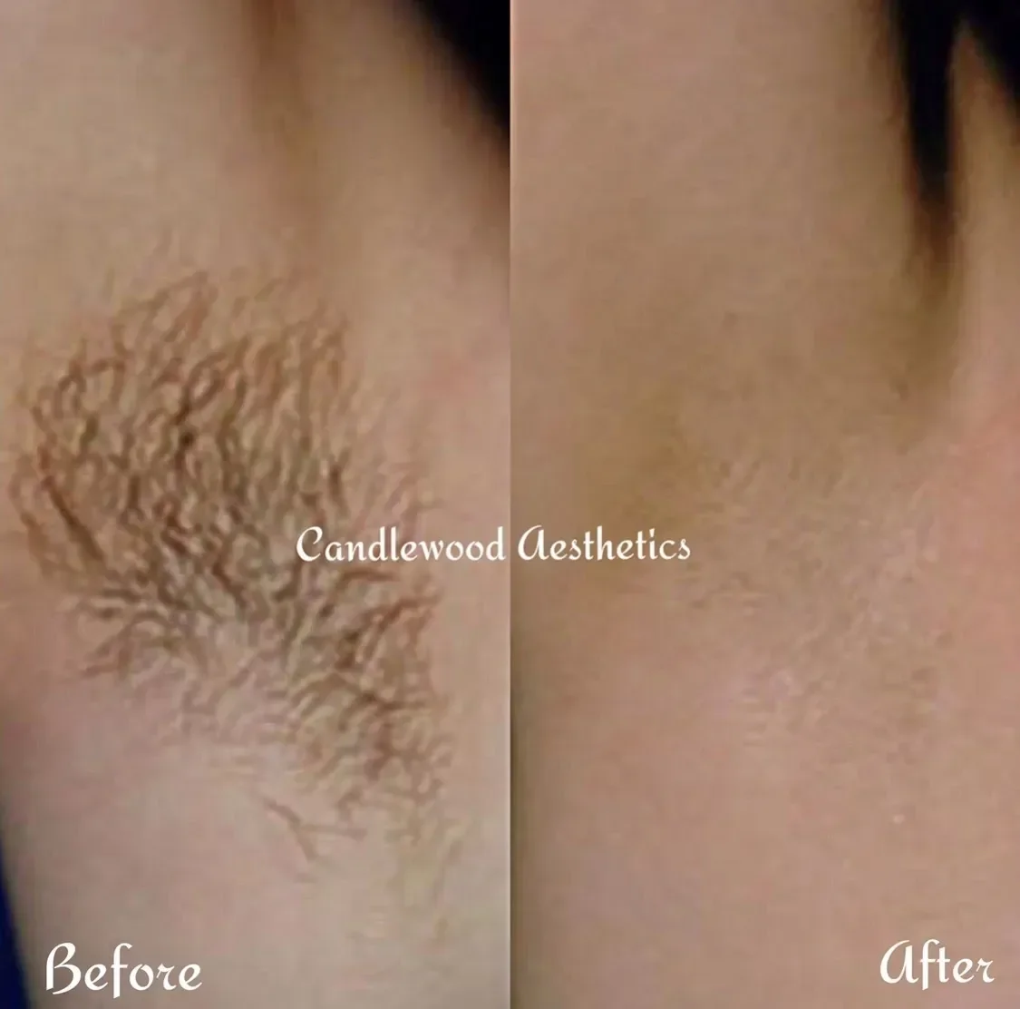 Close-up of a tattooed arm showing a before and after comparison of tattoo removal with the words 'Candlewood Aesthetics' in the center, left side labeled 'Before' with a large, detailed tattoo, right side labeled 'After' with clear skin and no tatto