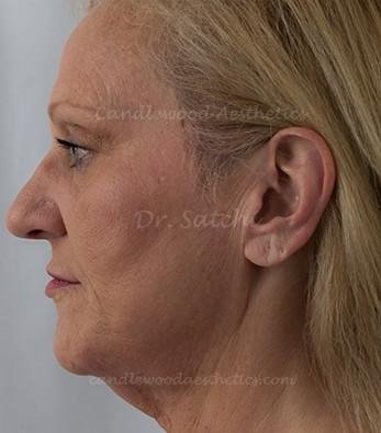 Profile view of a middle-aged woman with blonde hair, showing her nose, ear, and facial profile.