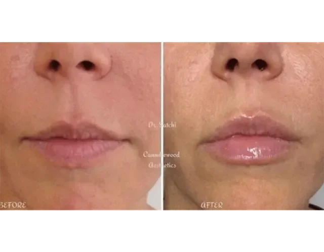 Comparison of a person's lips before and after a cosmetic lip procedure; the after photo shows glossy, fuller lips.