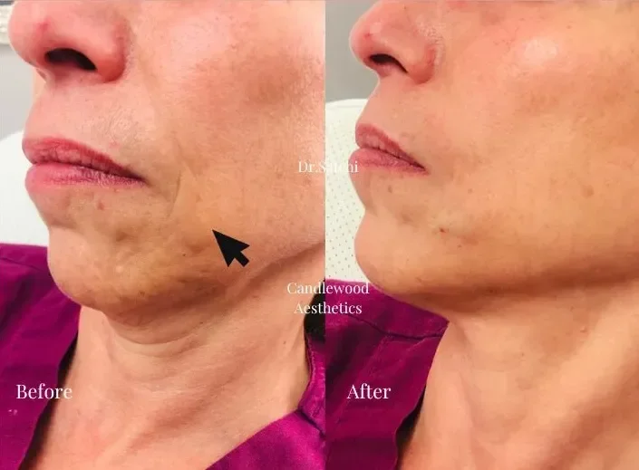 Side-by-side comparison of a woman's lower face and jawline before and after a cosmetic procedure, showing improvement in skin texture and reduction of sagging.