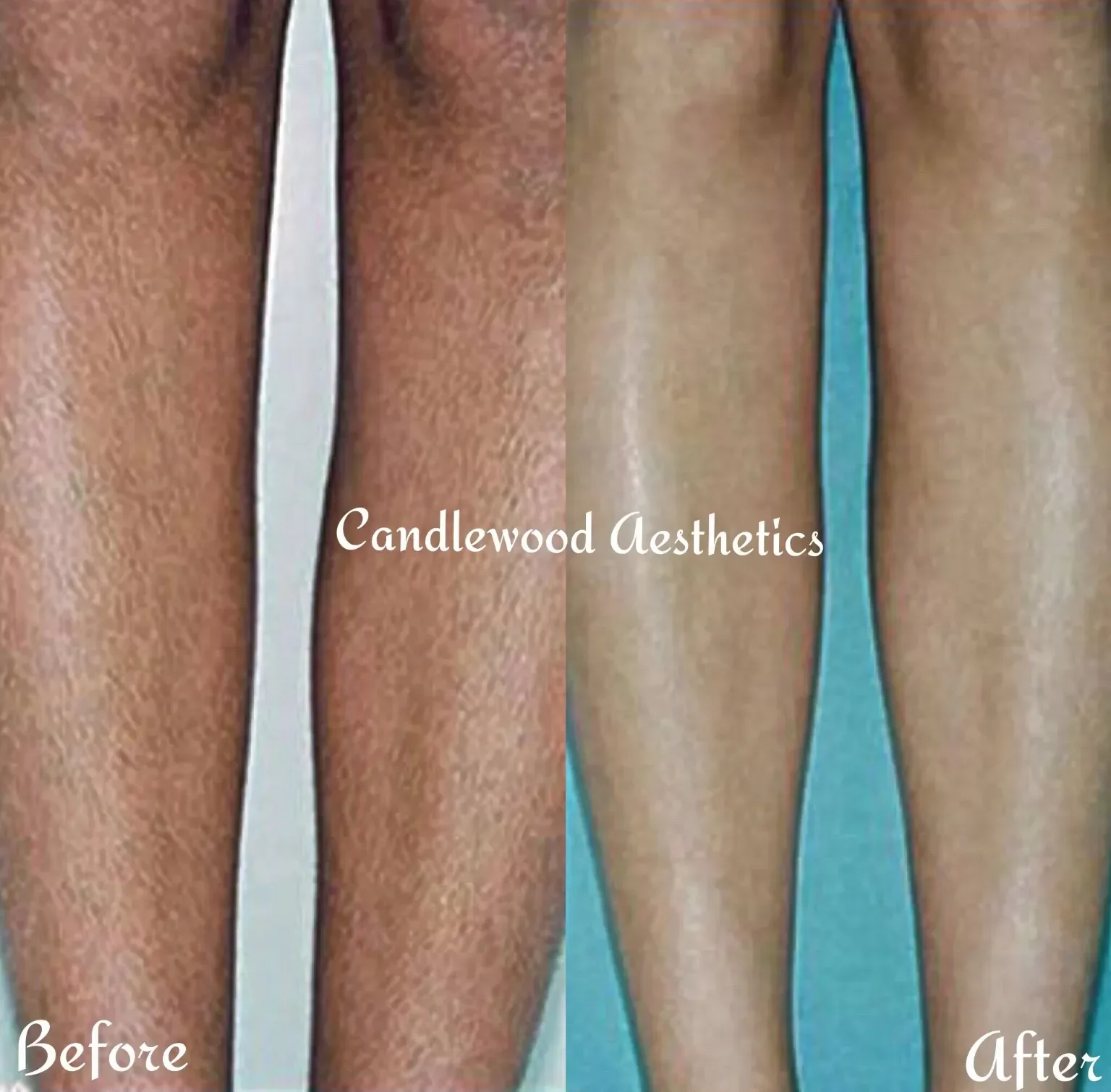 Comparison of a thigh before and after cosmetic treatment, showing improved skin tone and smoothness in the after image, with the text overlay 'Candlewood Aesthetics'.