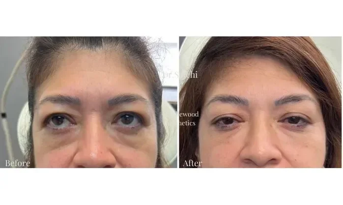 Side-by-side comparison of a woman's face showing before and after cosmetic treatment, highlighting reduced under-eye puffiness and dark circles.