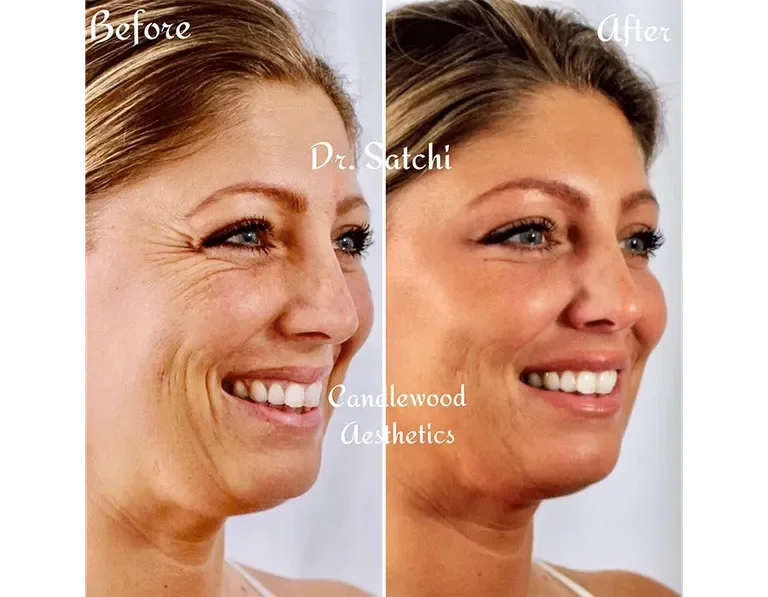 Side-by-side comparison of a woman's face before and after cosmetic treatment, showing reduced wrinkles and smoother skin, with text indicating 'Before' and 'After' and referencing Candlewood Aesthetics.