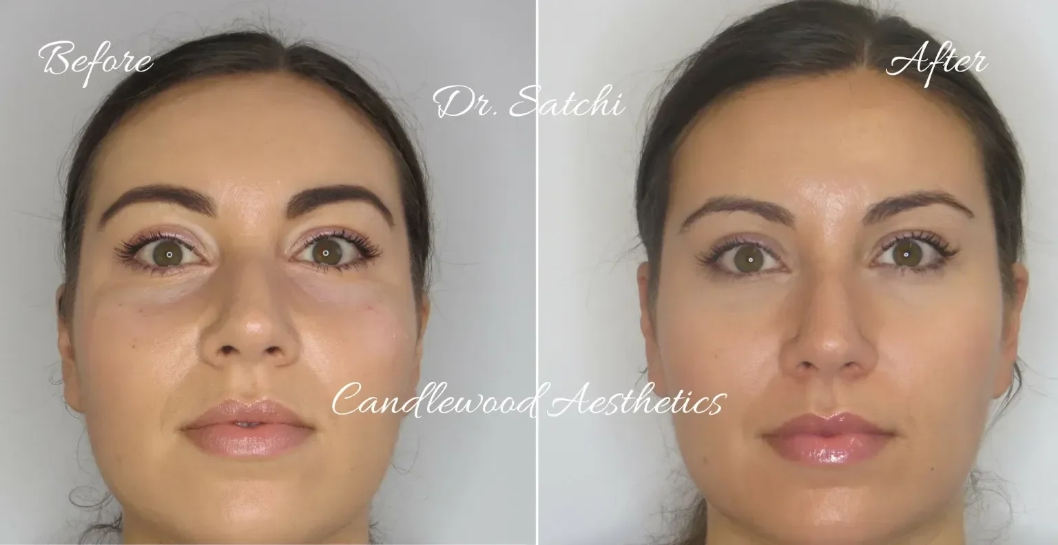 Before and after close-up photos of a woman's face showing cosmetic facial treatments, with the words before and after written on the images, and the name Candlewood Aesthetics and Dr. Satchi.