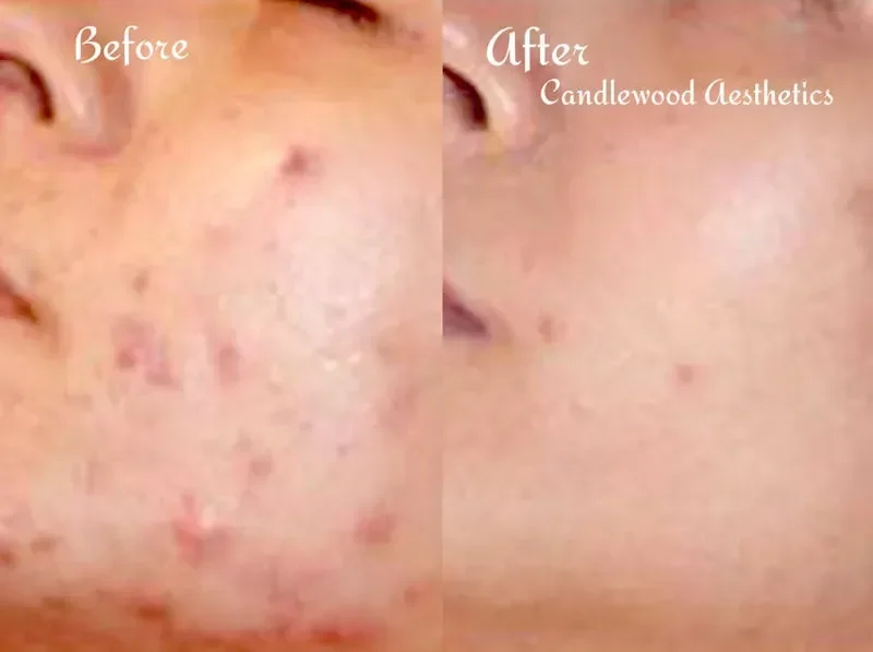Close-up of a woman's face showing a comparison of skin condition before and after treatment, with the 'before' side displaying acne, scars, and blemishes, and the 'after' side showing clearer, smoother skin. The text indicates the difference with 'B