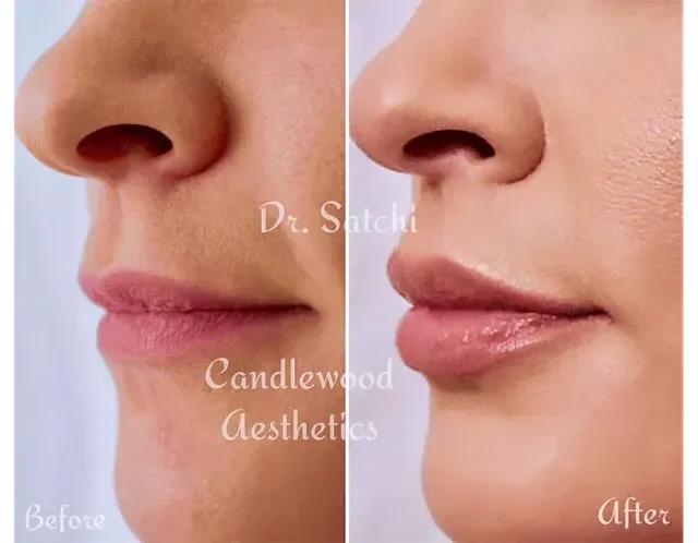 Close-up side-by-side comparison of a person's face before and after cosmetic treatment, showing improved skin texture and fuller lips.