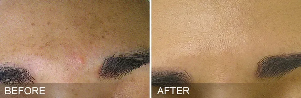 Close-up of a person's forehead showing before and after skincare, with the skin in the after image appearing clearer and smoother.