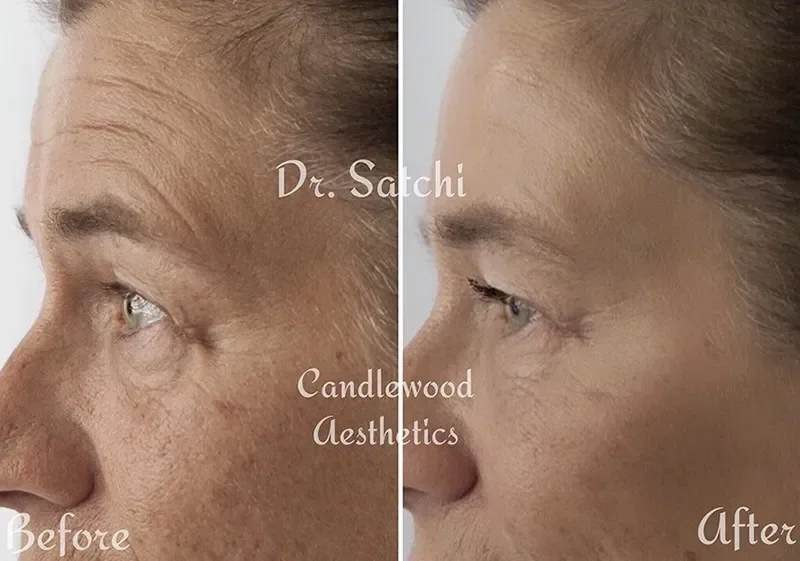 Side-by-side comparison of a woman's face showing skin improvement before and after skincare treatment by Candlewood Aesthetics, with the label 'Before' on the left and 'After' on the right.