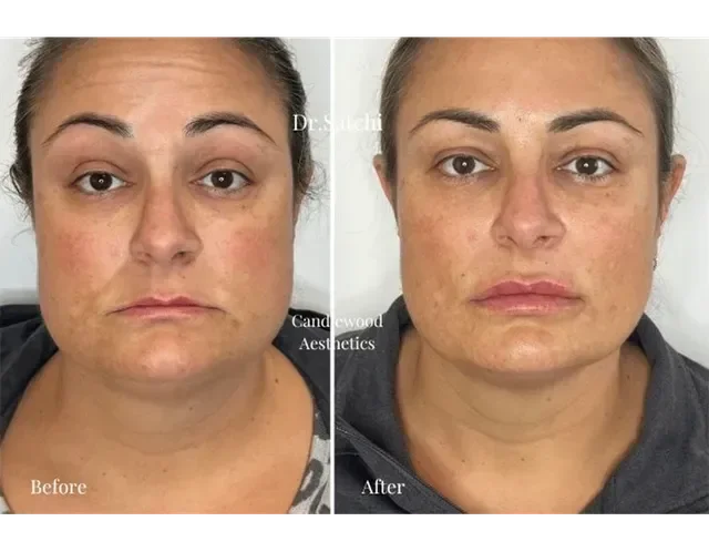 Side-by-side comparison of a woman's face before and after skincare treatment. The "before" shows more redness and uneven skin tone; the "after" shows clearer, smoother skin with improved texture.