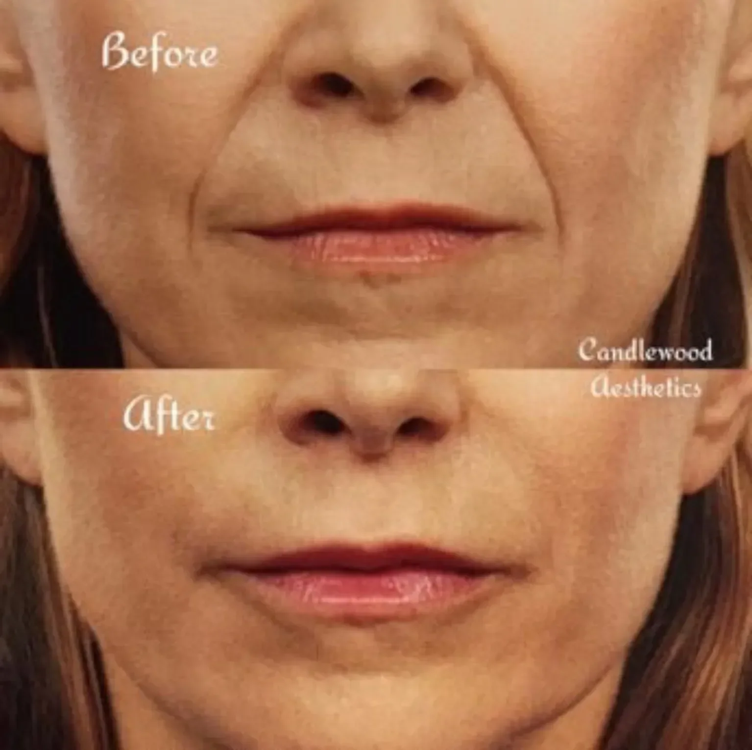 Close-up of a woman's lips showing before and after cosmetic lip enhancement, with text indicating the changes.