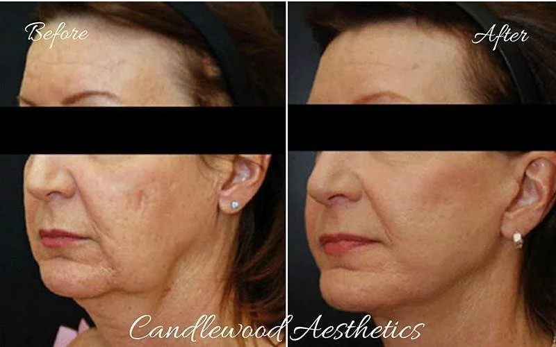 Comparison of a woman's face before and after cosmetic treatment, showing reduced wrinkles and improved skin texture.