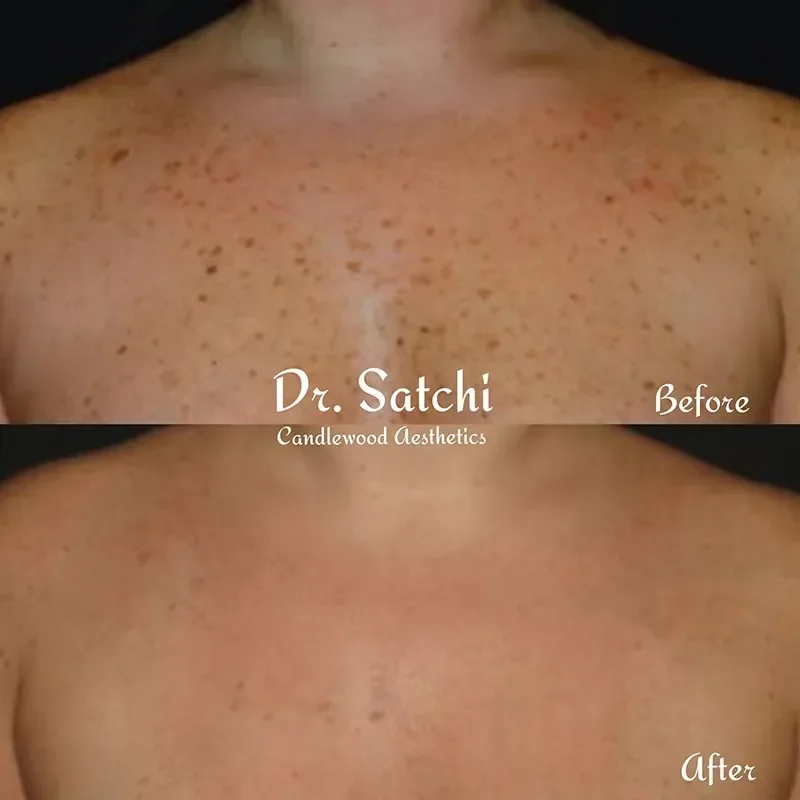 Comparison of a person's chest before and after skin treatment showing reduced redness and freckles.