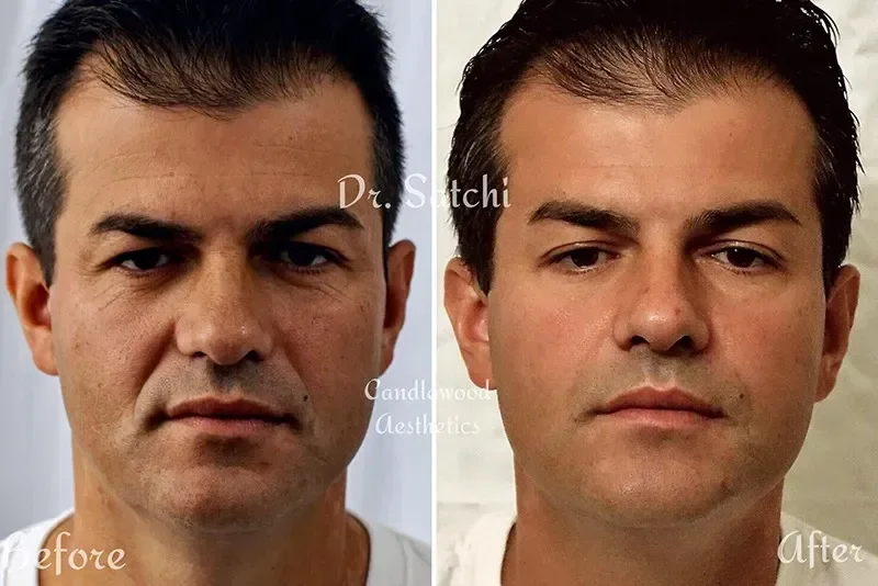 Side-by-side comparison of a man's face before and after cosmetic treatment, showing improved skin texture and appearance.