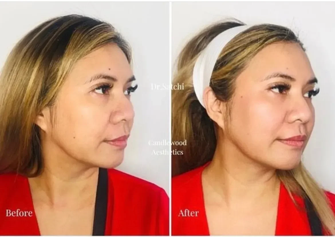 Side-by-side comparison photo showing a woman's face before and after cosmetic treatment. In the 'Before' image, she has sagging skin and less defined features. In the 'After' image, her skin appears tighter, and her facial features are more lifted and youthful.