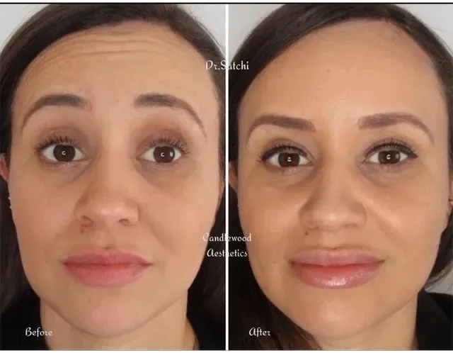 Side-by-side comparison of a woman's face before and after cosmetic treatment, showing smoother skin and enhanced facial features.
