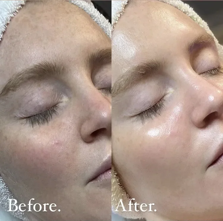 Comparison photo showing the face of a woman with the left side labeled 'Before' and the right side labeled 'After,' highlighting a skincare or cosmetic treatment result.
