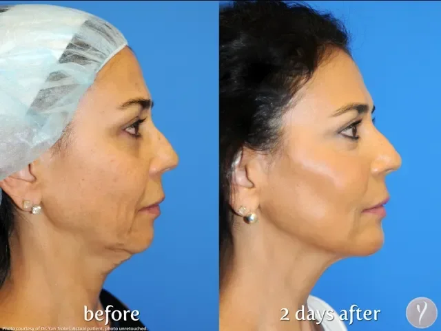 Side-by-side comparison of woman's profile before and two days after a cosmetic procedure, showing improvement in skin tightness and facial contour, with a blue background.