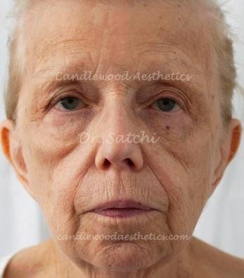 Close-up of an elderly woman's face with signs of aging, light skin, and short hair.