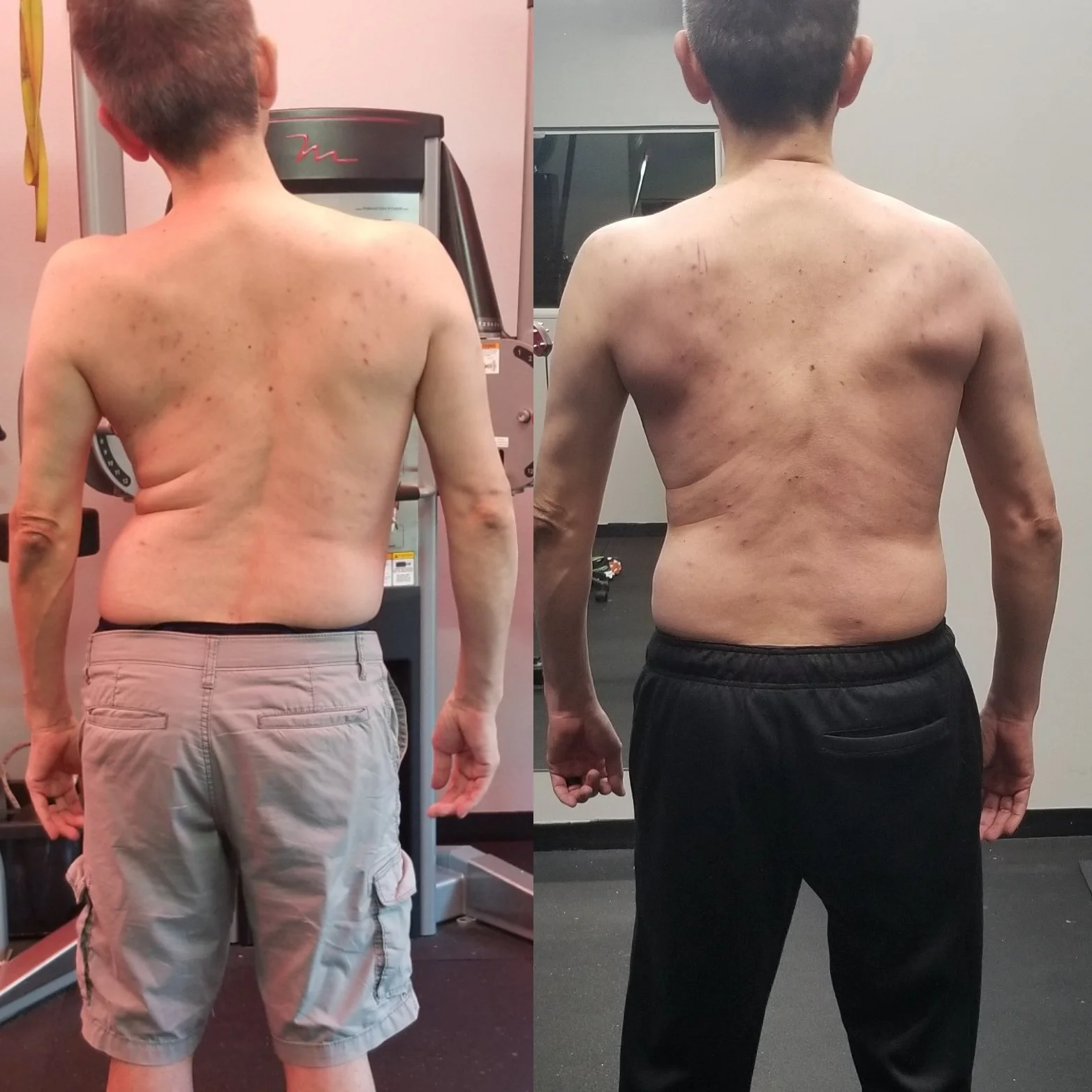 Four-month result: improved movement capacity in a client with cervical dystonia and scoliosis following complications from an experimental dental procedure—achieved through structured, biomechanics-driven training.