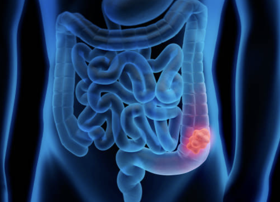Cancer de colon y recto.png