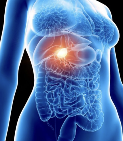 Cancer de vesicula.png