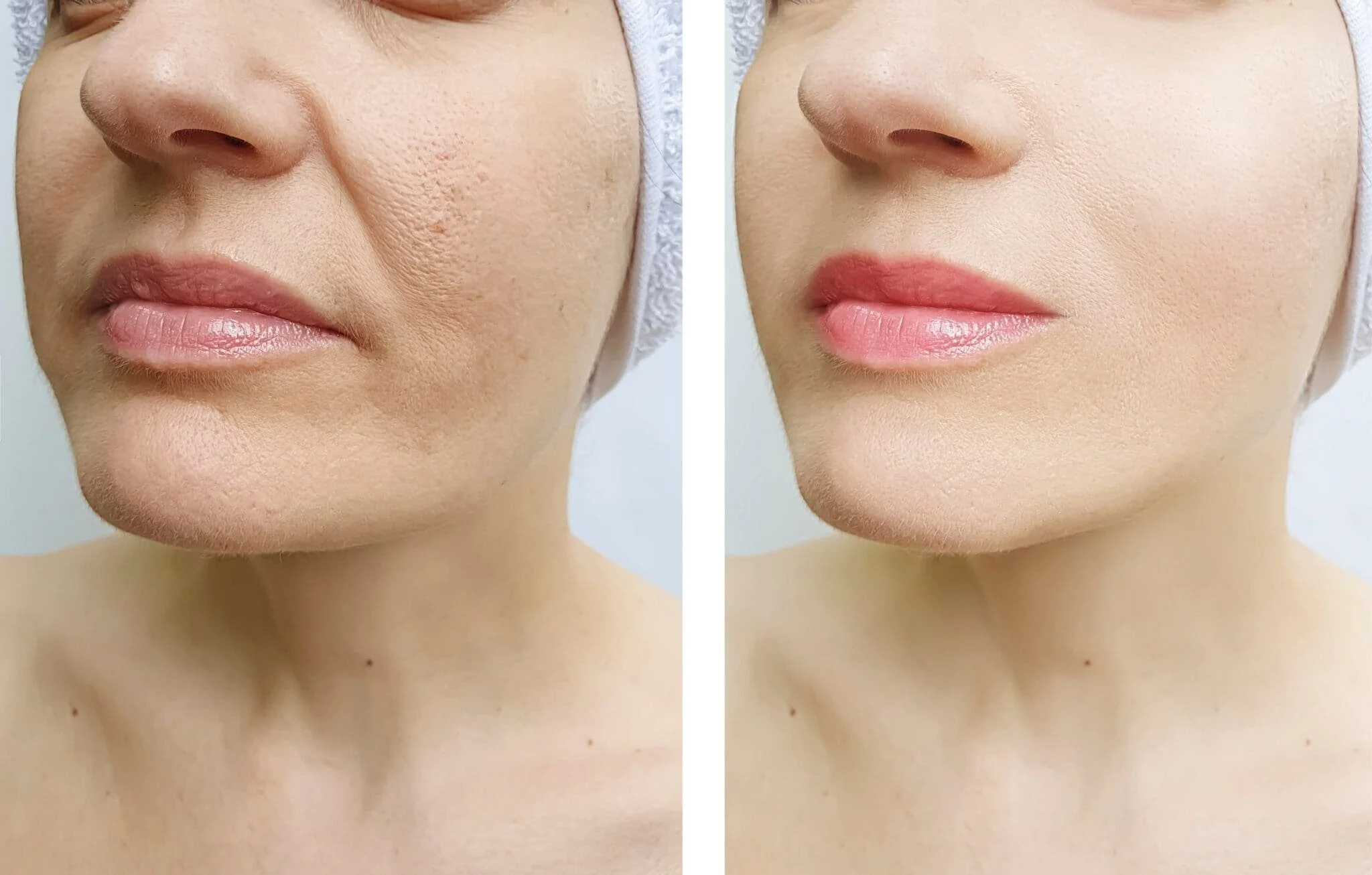 Side-by-side comparison photo of a woman's face before and after skincare treatment, showing clear skin and improved appearance.