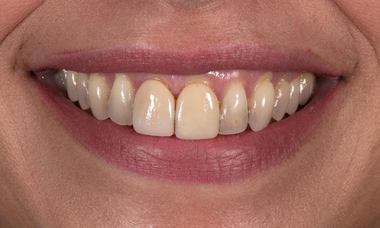 Smile Makeover Before — Ohana Dental | Dentist in Midland Park, NJ for Family, General &amp; Cosmetic Dentistry
