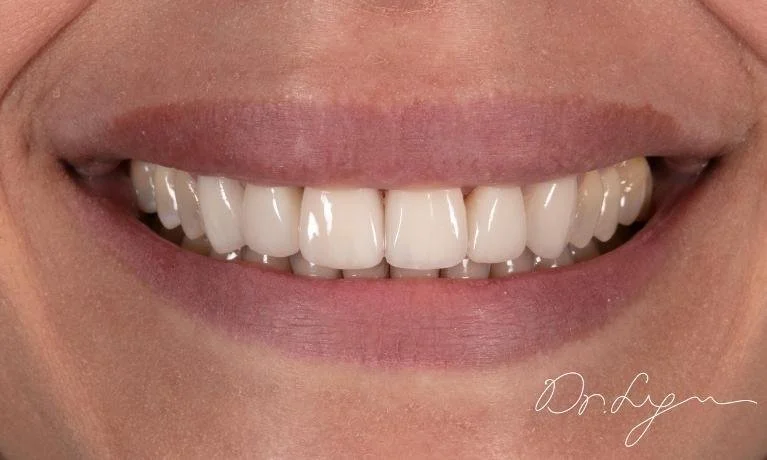Smile Makeover After — Ohana Dental | Dentist in Midland Park, NJ for Family, General &amp; Cosmetic Dentistry