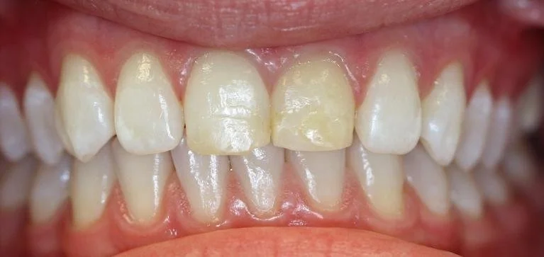 2 Front Teeth Crowns Before — Ohana Dental | Dentist in Midland Park, NJ for Family, General &amp; Cosmetic Dentistry