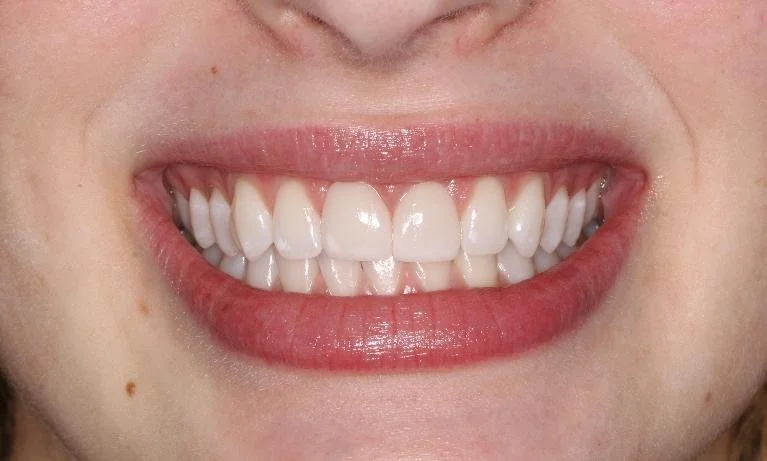 2 Front Teeth Crowns After — Ohana Dental | Dentist in Midland Park, NJ for Family, General &amp; Cosmetic Dentistry