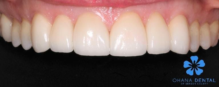 6 Veneer Replacement After — Ohana Dental | Dentist in Midland Park, NJ for Family, General &amp; Cosmetic Dentistry
