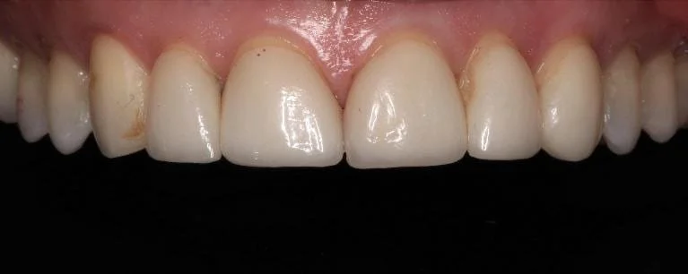 6 Veneer Replacement Before — Ohana Dental | Dentist in Midland Park, NJ for Family, General &amp; Cosmetic Dentistry