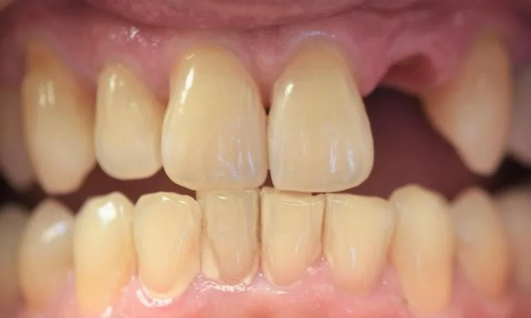 Implant to Replace a Missing Front Tooth Before — Ohana Dental | Dentist in Midland Park, NJ for Family, General &amp; Cosmetic Dentistry