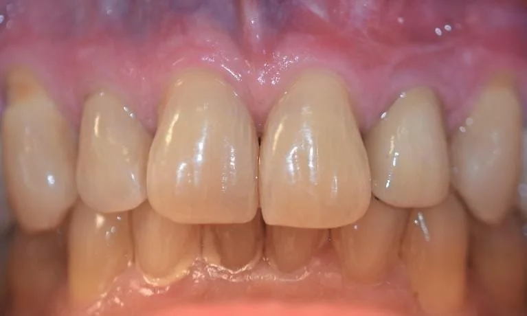 Implant to Replace a Missing Front Tooth After — Ohana Dental | Dentist in Midland Park, NJ for Family, General &amp; Cosmetic Dentistry