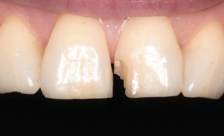 Single Veneer&nbsp;Before — Ohana Dental | Dentist in Midland Park, NJ for Family, General &amp; Cosmetic Dentistry