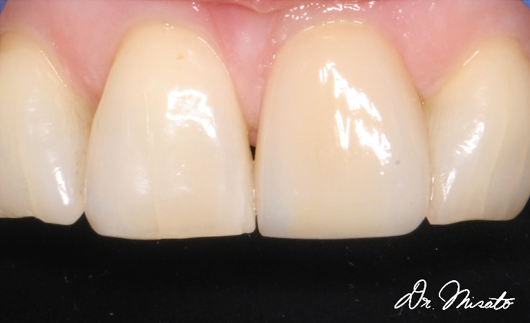 Single Veneer&nbsp;After — Ohana Dental | Dentist in Midland Park, NJ for Family, General &amp; Cosmetic Dentistry