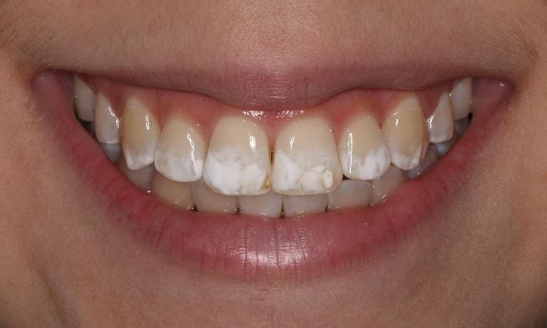 ICON White Spot Removal Before — Ohana Dental | Dentist in Midland Park, NJ for Family, General &amp; Cosmetic Dentistry