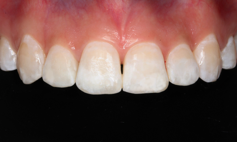 ICON White Spot Removal After — Ohana Dental | Dentist in Midland Park, NJ for Family, General &amp; Cosmetic Dentistry