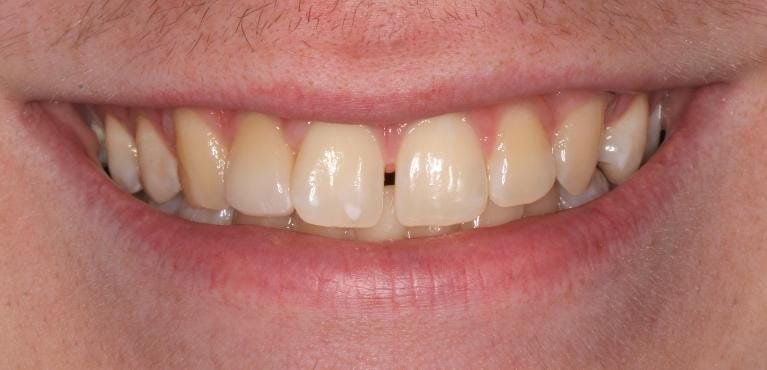 Single Veneer After — Ohana Dental | Dentist in Midland Park, NJ for Family, General &amp; Cosmetic Dentistry