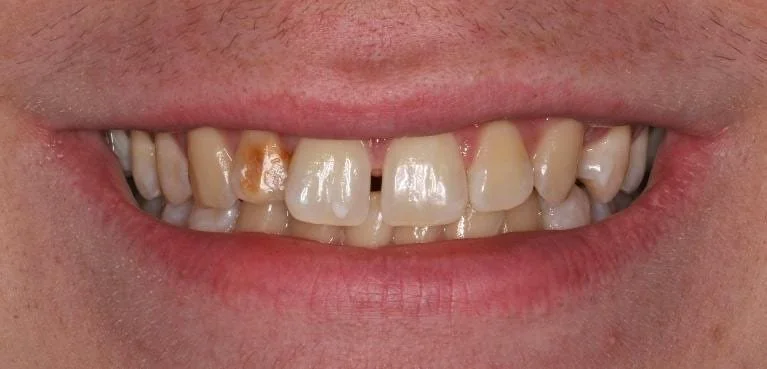 Single Veneer Before — Ohana Dental | Dentist in Midland Park, NJ for Family, General &amp; Cosmetic Dentistry