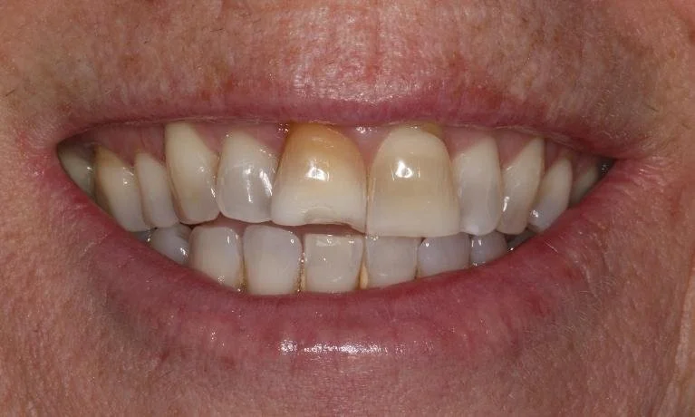 Two Front Veneers Smile Transformation Before — Ohana Dental | Dentist in Midland Park, NJ for Family, General &amp; Cosmetic Dentistry