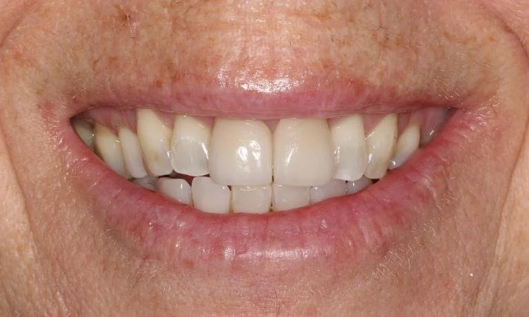 Two Front Veneers Smile Transformation After — Ohana Dental | Dentist in Midland Park, NJ for Family, General &amp; Cosmetic Dentistry