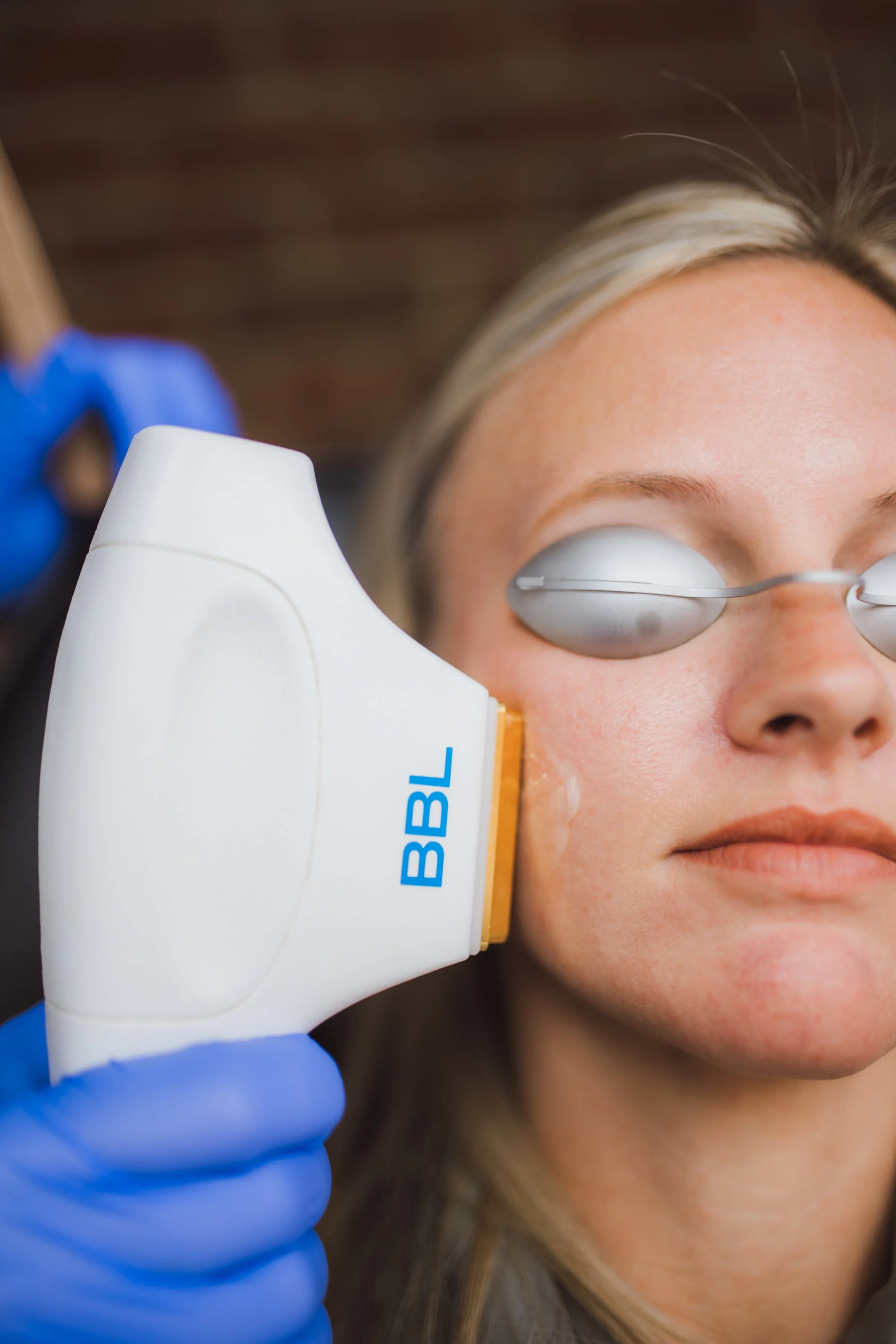 A woman is getting a facial treatment with a handheld device labeled 'BBL' applied to her cheek. She is wearing protective goggles and has a calm expression. The person administering the treatment is wearing blue gloves.